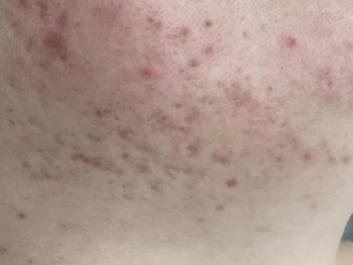 Acne-na.webp