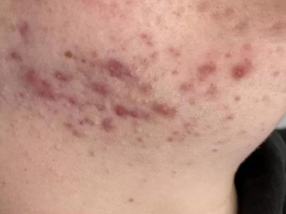 Acne-voor.webp